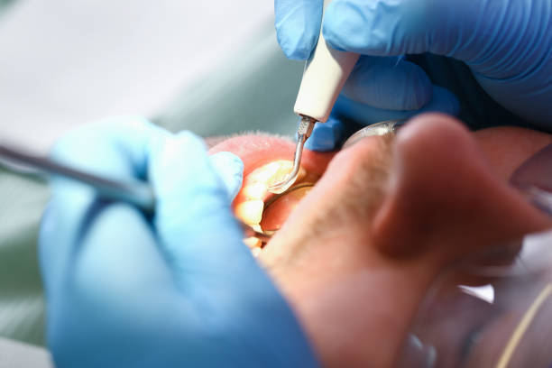 Best Emergency Wisdom Teeth Removal in Lake Holm, WA