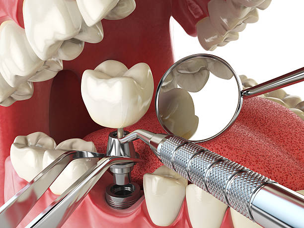 Best Emergency Tooth Extraction in Lake Holm, WA
